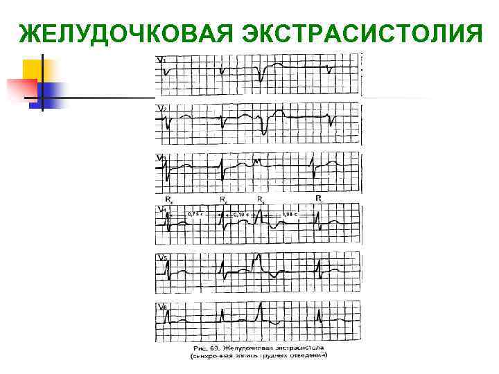 Экстрасистолия карта вызова