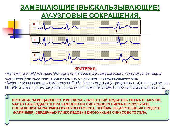 ЗАМЕЩАЮЩИЕ (ВЫСКАЛЬЗЫВАЮЩИЕ) AV-УЗЛОВЫЕ СОКРАЩЕНИЯ. II II II КРИТЕРИИ: • Напоминают AV-узловые ЭС, однако интервал