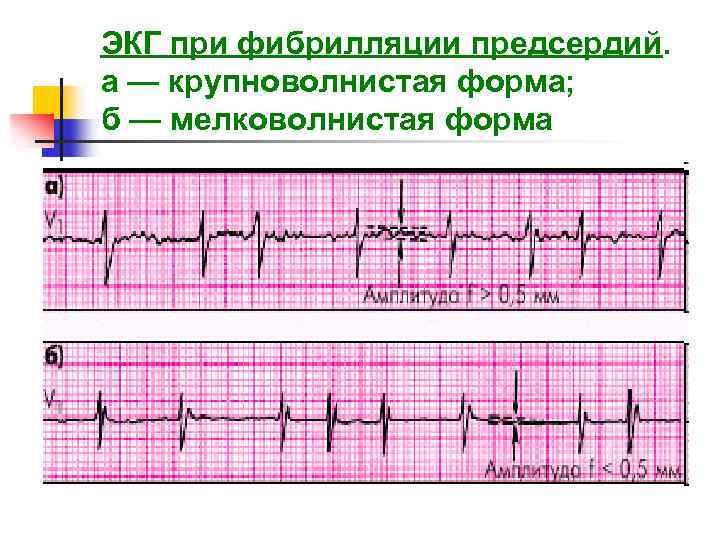 Экг при фибрилляции предсердий картинки