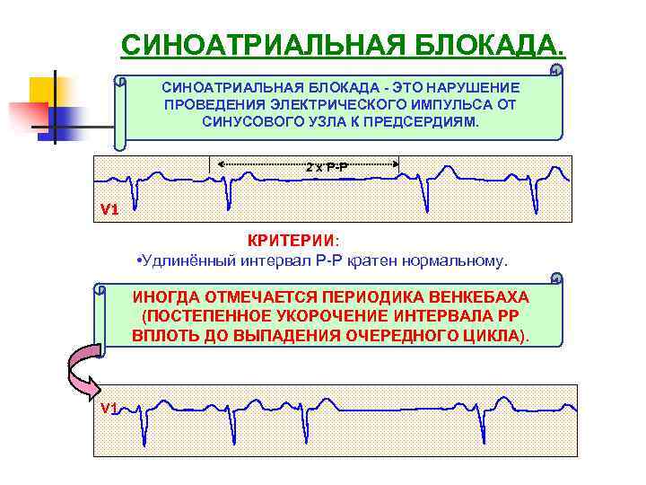 СИНОАТРИАЛЬНАЯ БЛОКАДА - ЭТО НАРУШЕНИЕ ПРОВЕДЕНИЯ ЭЛЕКТРИЧЕСКОГО ИМПУЛЬСА ОТ СИНУСОВОГО УЗЛА К ПРЕДСЕРДИЯМ. 2