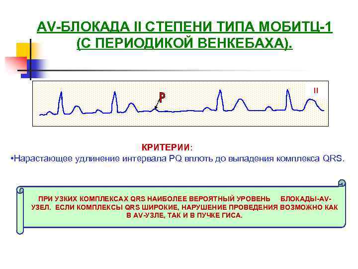 АV-БЛОКАДА II СТЕПЕНИ ТИПА МОБИТЦ-1 (С ПЕРИОДИКОЙ ВЕНКЕБАХА). II КРИТЕРИИ: • Нарастающее удлинение интервала