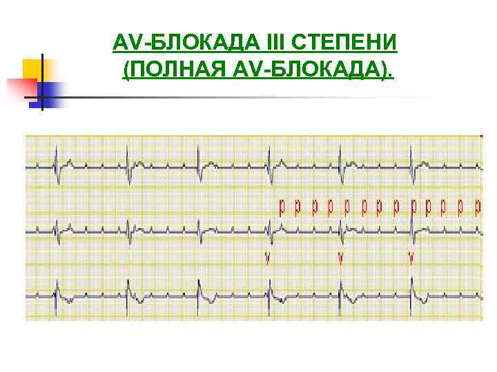 AV-БЛОКАДА III СТЕПЕНИ (ПОЛНАЯ AV-БЛОКАДА). 