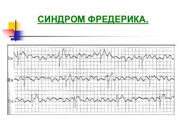 Синдром фредерика на экг фото