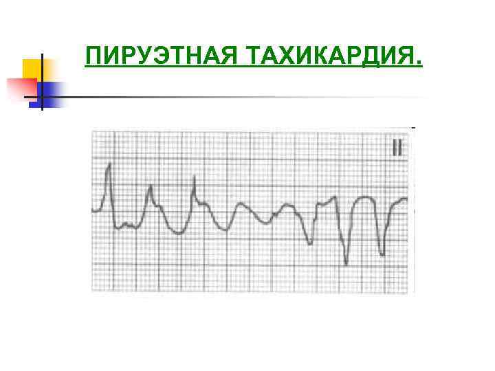 ПИРУЭТНАЯ ТАХИКАРДИЯ. 