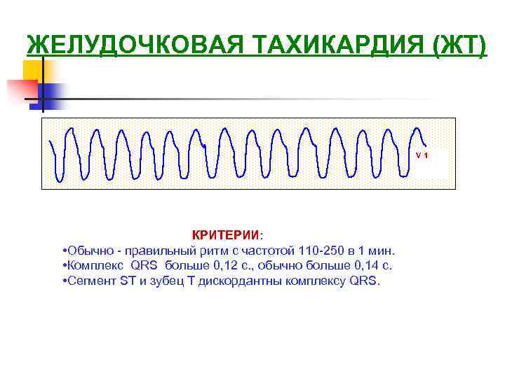 ЖЕЛУДОЧКОВАЯ ТАХИКАРДИЯ (ЖТ) V 1 КРИТЕРИИ: • Обычно - правильный ритм с частотой 110