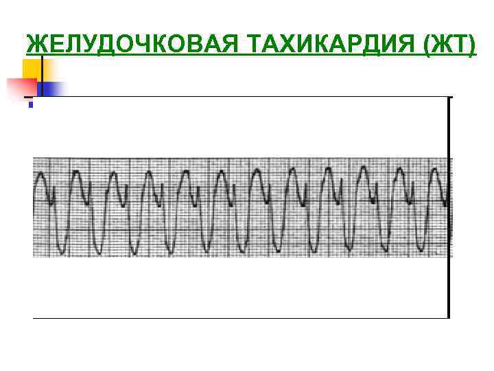 ЖЕЛУДОЧКОВАЯ ТАХИКАРДИЯ (ЖТ) 