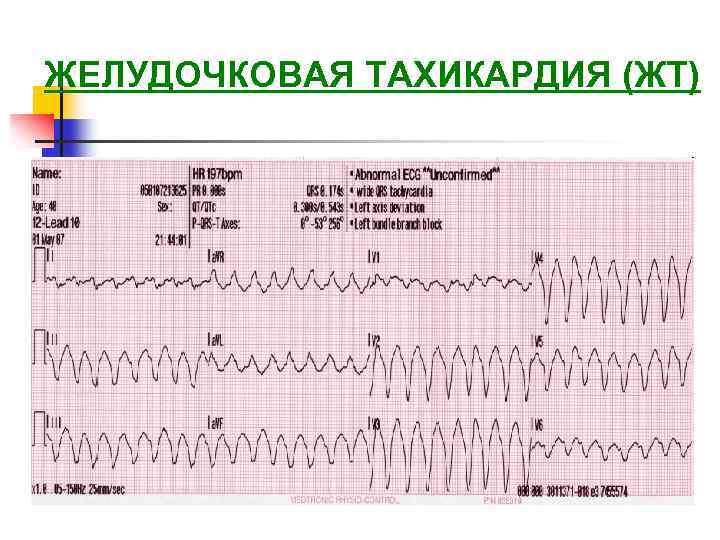 Тахикардия на экг