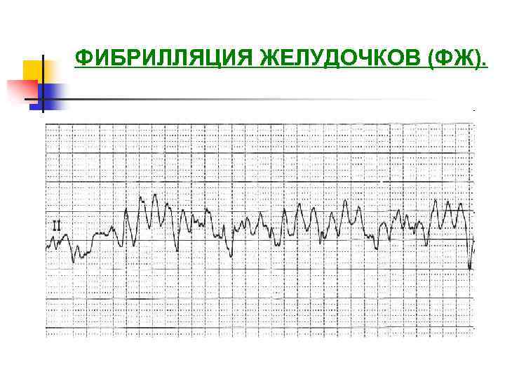 ФИБРИЛЛЯЦИЯ ЖЕЛУДОЧКОВ (ФЖ). 