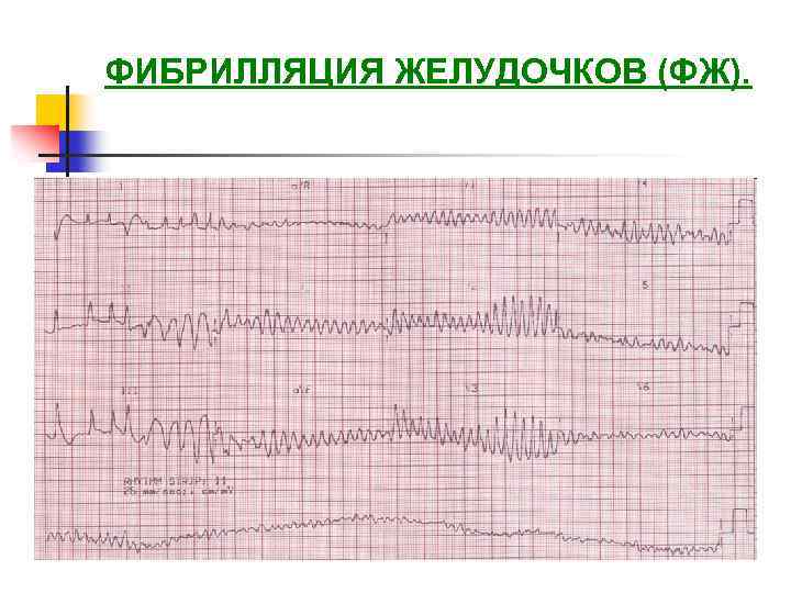 Фибрилляция желудочков на экг картинки