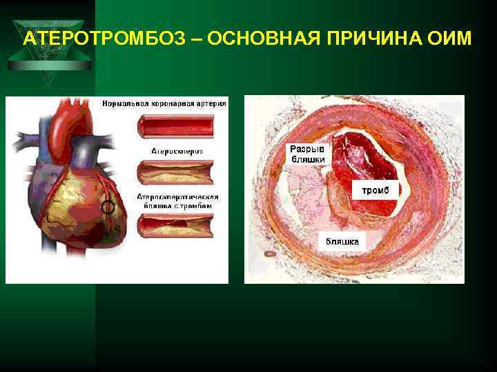 АТЕРОТРОМБОЗ – ОСНОВНАЯ ПРИЧИНА ОИМ 
