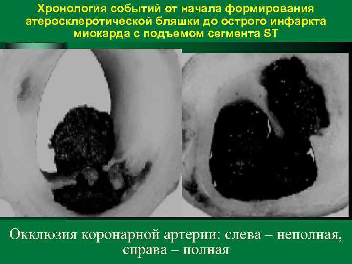 Хронология событий от начала формирования атеросклеротической бляшки до острого инфаркта миокарда с подъемом сегмента