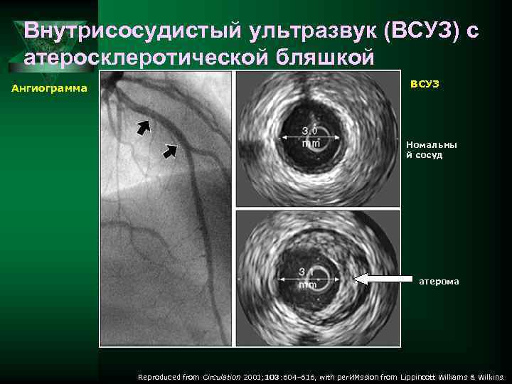 Внутрисосудистый ультразвук (ВСУЗ) с атеросклеротической бляшкой Ангиограмма ВСУЗ Номальны й сосуд атерома Reproduced from