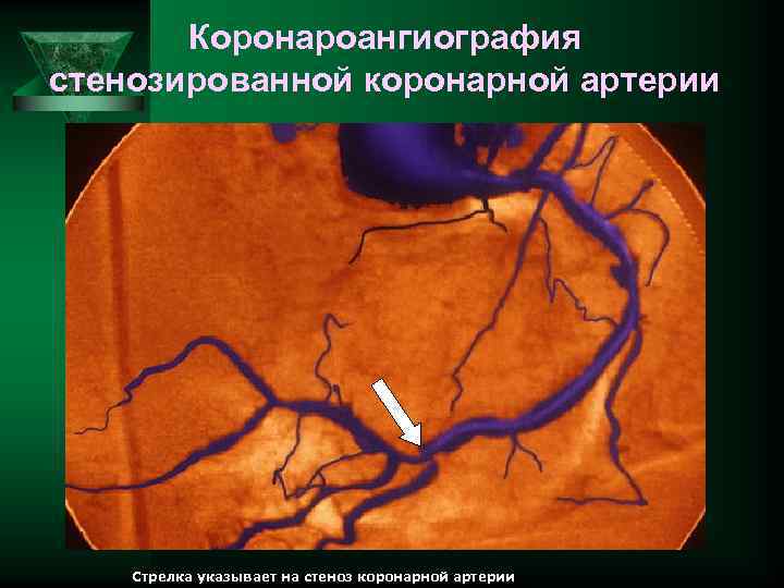 Коронароангиография стенозированной коронарной артерии 6 Стрелка указывает на стеноз коронарной артерии 