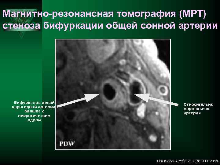 Магнитно-резонансная томография (МРТ) стеноза бифуркации общей сонной артерии Бифуркация левой каротидной артерии: бляшка с