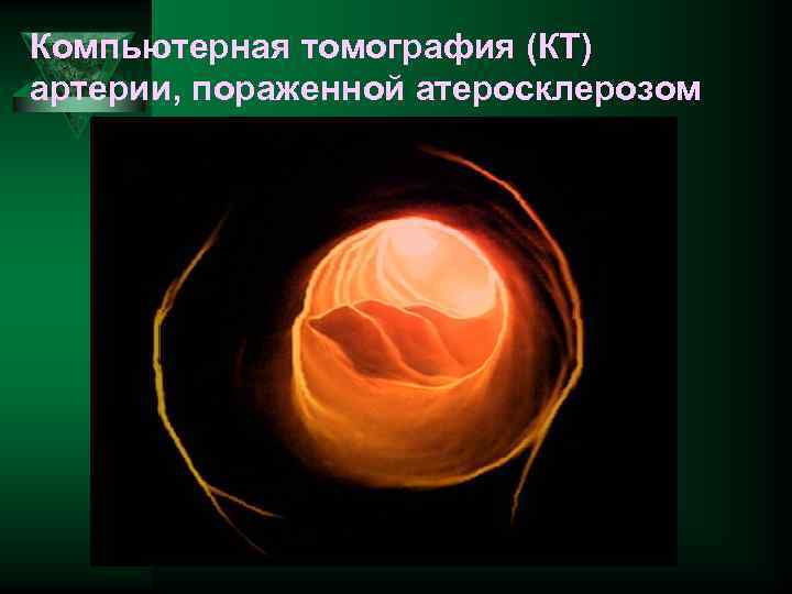 Компьютерная томография (КТ) артерии, пораженной атеросклерозом 