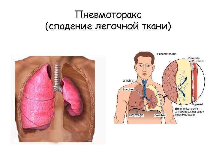 Пневмоторакс (спадение легочной ткани) 