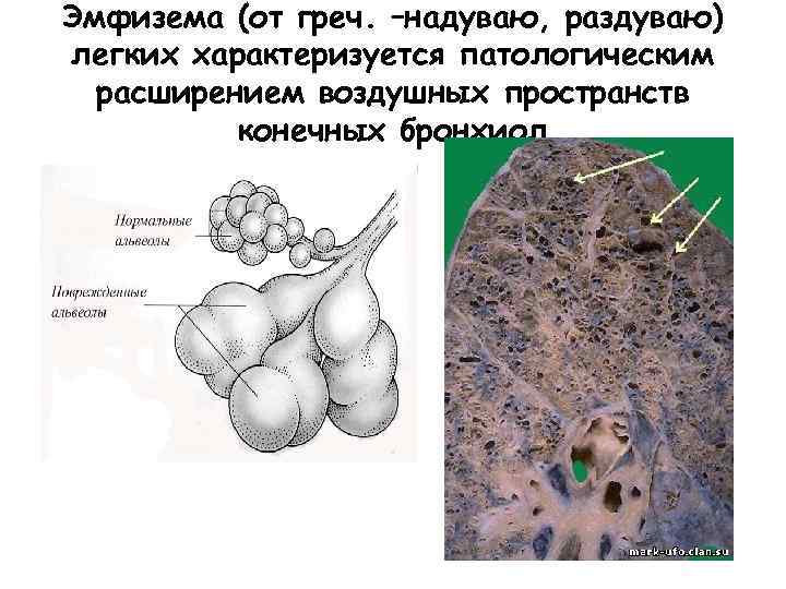 Эмфизема легких карта вызова