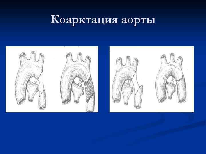 Коарктация аорты форум