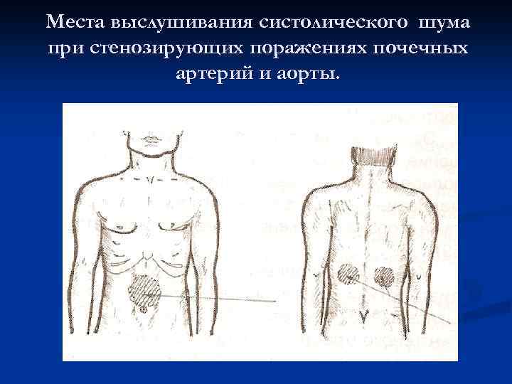 Аорта выслушивается