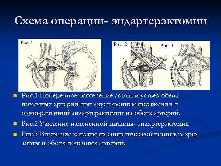 Схема операции- эндартерэктомии n n n Рис. 1 Поперечное рассечение аорты и устьев обеих