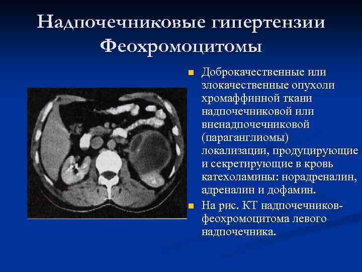 Надпочечниковые гипертензии Феохромоцитомы n n Доброкачественные или злокачественные опухоли хромаффинной ткани надпочечниковой или вненадпочечниковой