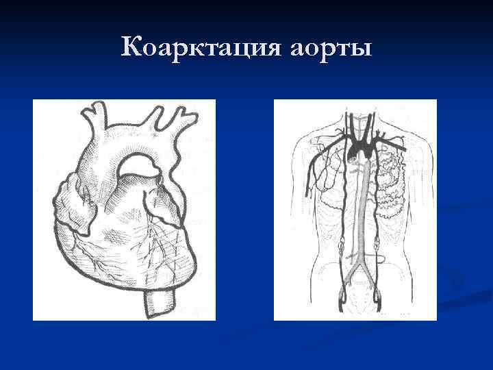 Коарктация аорты 