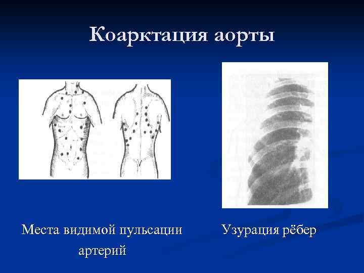 Коарктация аорты Места видимой пульсации артерий Узурация рёбер 