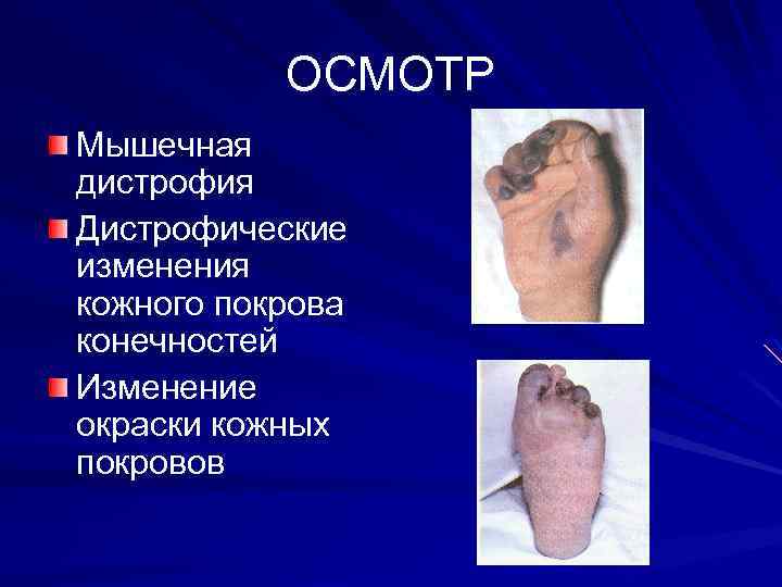 ОСМОТР Мышечная дистрофия Дистрофические изменения кожного покрова конечностей Изменение окраски кожных покровов 