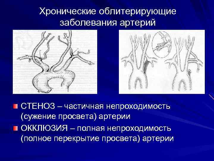 Острая артериальная непроходимость презентация хирургия