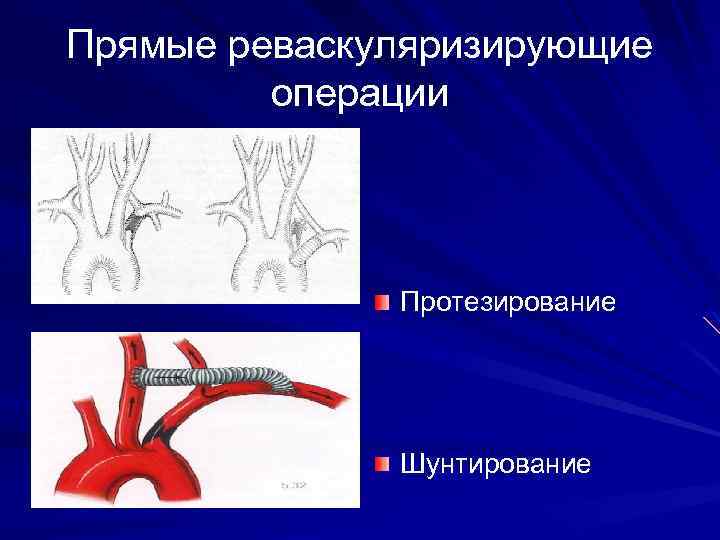 Прямые реваскуляризирующие операции Протезирование Шунтирование 