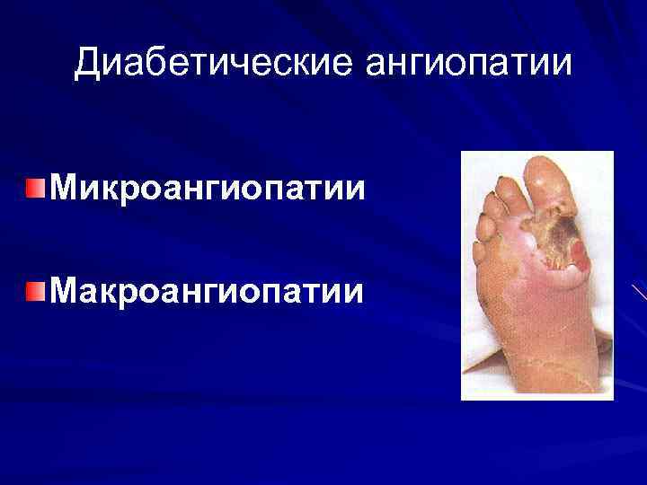 Диабетические ангиопатии Микроангиопатии Макроангиопатии 