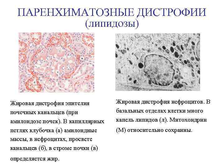 ПАРЕНХИМАТОЗНЫЕ ДИСТРОФИИ (липидозы) Жировая дистрофия эпителия почечных канальцев (при амилоидозе почек). В капиллярных петлях