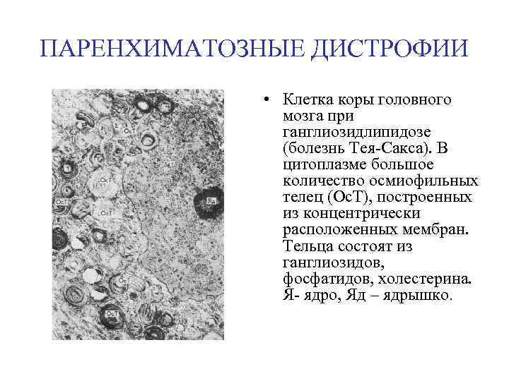 ПАРЕНХИМАТОЗНЫЕ ДИСТРОФИИ • Клетка коры головного мозга при ганглиозидлипидозе (болезнь Тея-Сакса). В цитоплазме большое