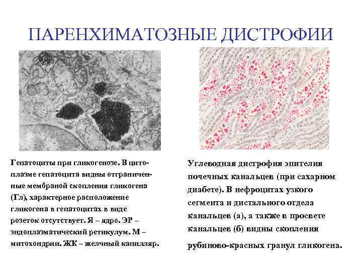 ПАРЕНХИМАТОЗНЫЕ ДИСТРОФИИ Гепатоциты при гликогенозе. В цитоплазме гепатоцита видны отграниченные мембраной скопления гликогена (Гл),