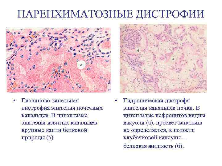 ПАРЕНХИМАТОЗНЫЕ ДИСТРОФИИ • Гиалиново-капельная дистрофия эпителия почечных канальцев. В цитоплазме эпителия извитых канальцев крупные