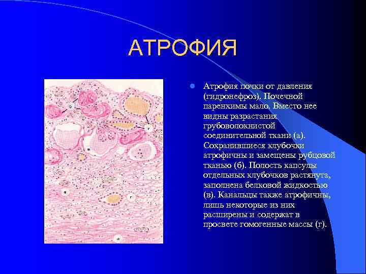 АТРОФИЯ l Атрофия почки от давления (гидронефроз). Почечной паренхимы мало. Вместо нее видны разрастания