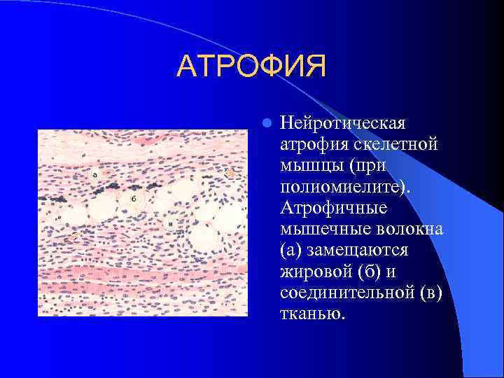 АТРОФИЯ l Нейротическая атрофия скелетной мышцы (при полиомиелите). Атрофичные мышечные волокна (а) замещаются жировой