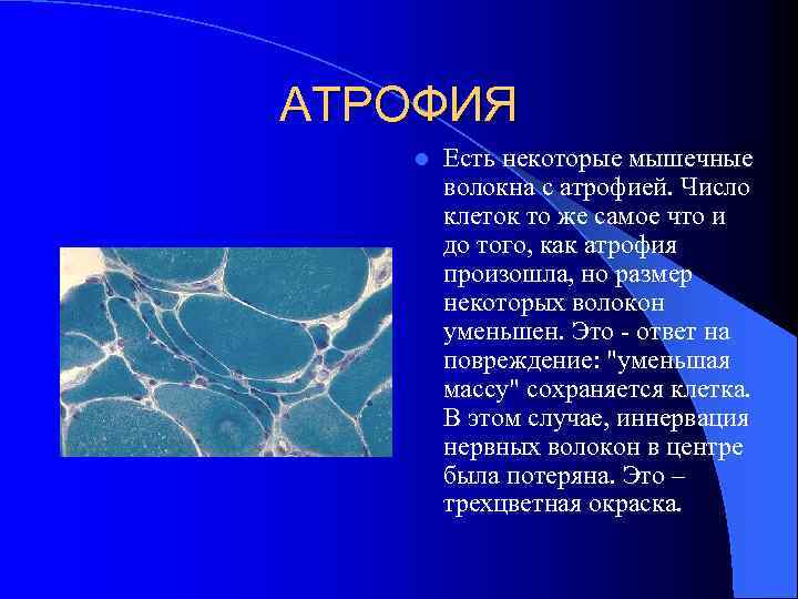 АТРОФИЯ l Есть некоторые мышечные волокна с атрофией. Число клеток то же самое что