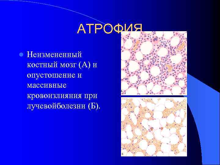 АТРОФИЯ l Неизмененный костный мозг (А) и опустошение и массивные кровоизлияния при лучевойболезни (Б).