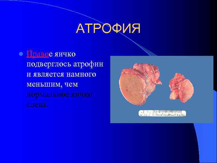 АТРОФИЯ l Правое яичко подверглось атрофии и является намного меньшим, чем нормальное яичко слева.