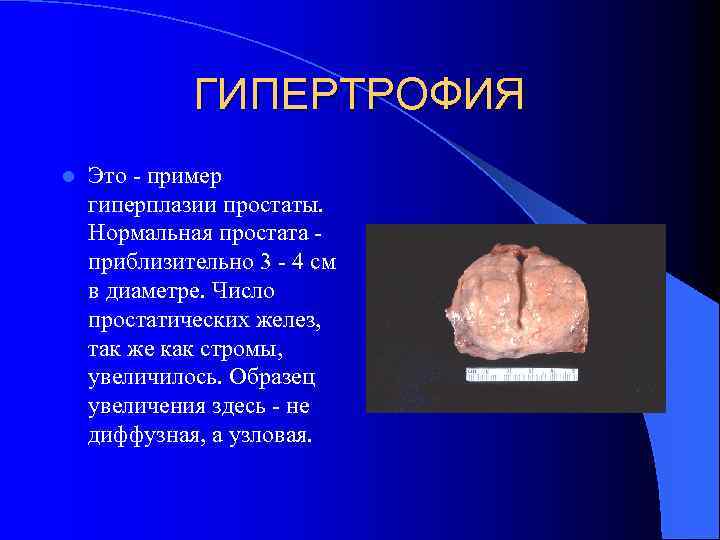 ГИПЕРТРОФИЯ l Это - пример гиперплазии простаты. Нормальная простата - приблизительно 3 - 4