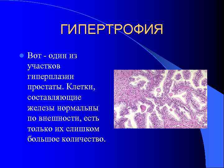 ГИПЕРТРОФИЯ l Вот - один из участков гиперплазии простаты. Клетки, составляющие железы нормальны по