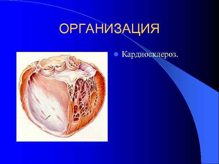 ОРГАНИЗАЦИЯ l Кардиосклероз. 