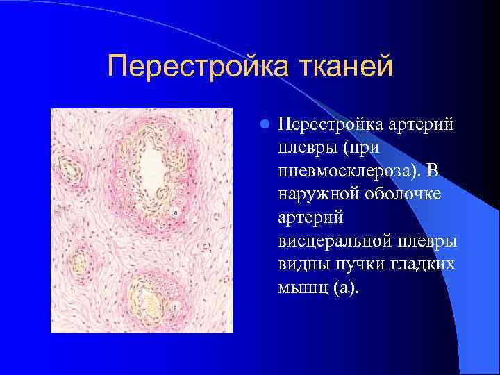 Перестройка тканей l Перестройка артерий плевры (при пневмосклероза). В наружной оболочке артерий висцеральной плевры