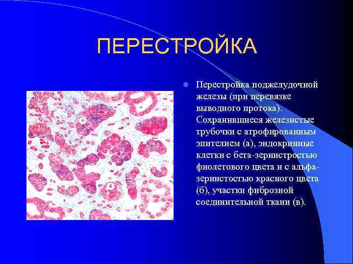 ПЕРЕСТРОЙКА l Перестройка поджелудочной железы (при перевязке выводного протока). Сохранившиеся железистые трубочки с атрофированным