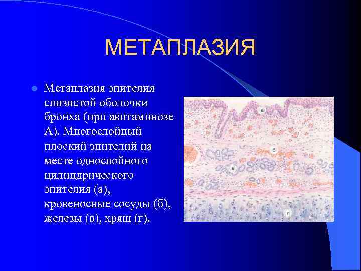 МЕТАПЛАЗИЯ l Метаплазия эпителия слизистой оболочки бронха (при авитаминозе А). Многослойный плоский эпителий на