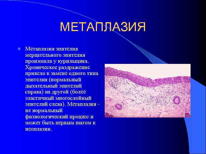 МЕТАПЛАЗИЯ l Метаплазия эпителия мерцательного эпителия произошла у курильщика. Хроническое раздражение привело к замене