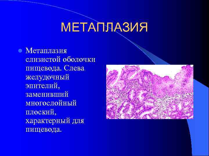 МЕТАПЛАЗИЯ l Метаплазия слизистой оболочки пищевода. Слева желудочный эпителий, заменивший многослойный плоский, характерный для