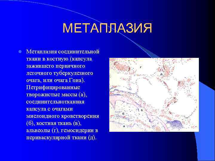 МЕТАПЛАЗИЯ l Метаплазия соединительной ткани в костную (капсула зажившего первичного легочного туберкулезного очага, или