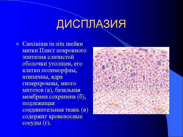 ДИСПЛАЗИЯ l Carcinima in situ шейки матки Пласт покровного эпителия слизистой оболочки утолщен, его